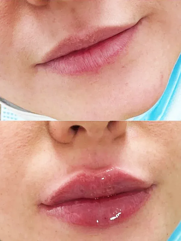 Mărire buze cu Acid Hialuronic - Dr Raluca Harnagea — Sector 1, București