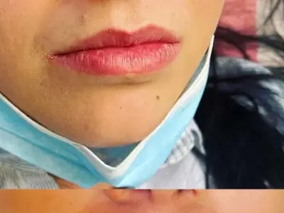 Imagine 3 · Mărire buze cu Acid Hialuronic - Dr Raluca Harnagea
