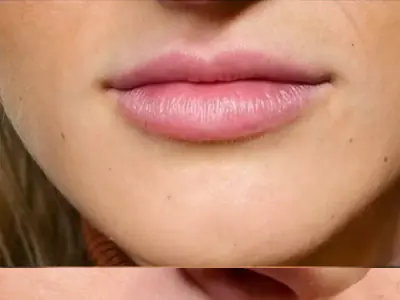 Imagine 2 · Mărire buze cu Acid Hialuronic - Dr Raluca Harnagea