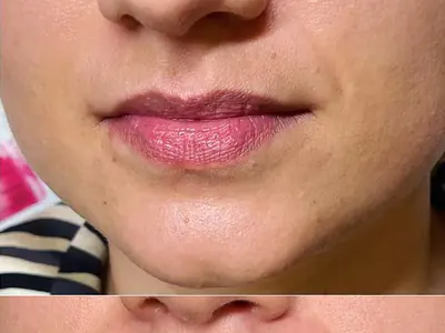 Imagine 5 · Mărire buze cu Acid Hialuronic - Dr Raluca Harnagea